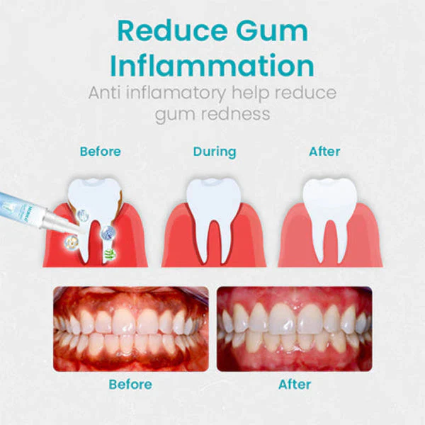 🔥Last Day 69% OFF-SEURICO™ Gum Shield Therapy Gel - Image 7